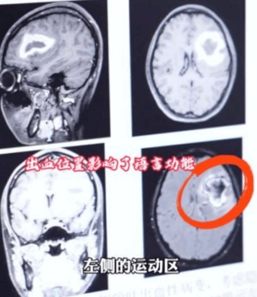 Китаянка, хорошо владевшая английским языком, внезапно потеряла способность говорить на нём